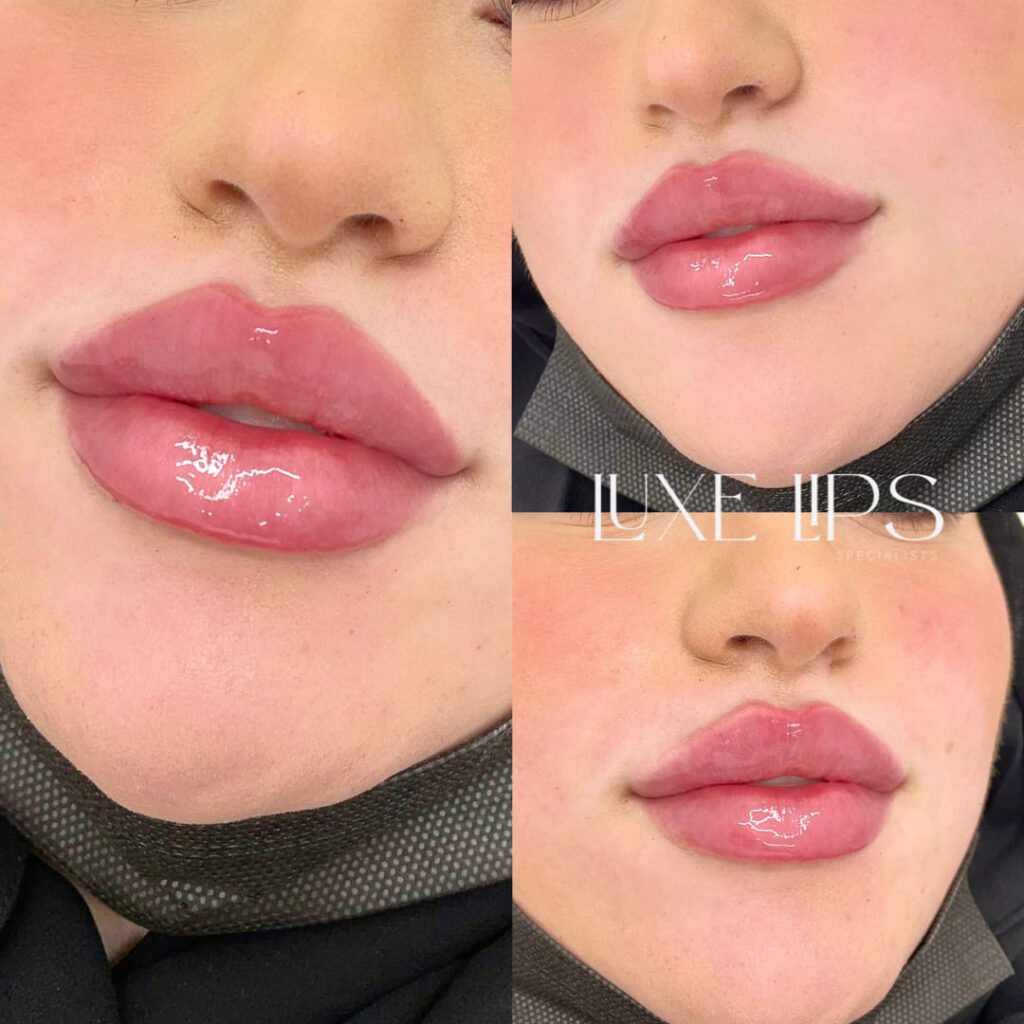 Luxe Lips Specialists Moonee Ponds
